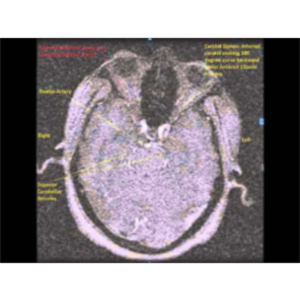 Tracking Brain Circulation via 2-D TOF MRI Slices – Sanjoy Sanyal icon