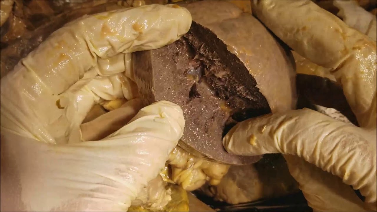 Stomach-Duodenum-Spleen-Gallbladder-Liver-Morison Pouch - Realtime Dissection - Sanjoy Sanyal icon