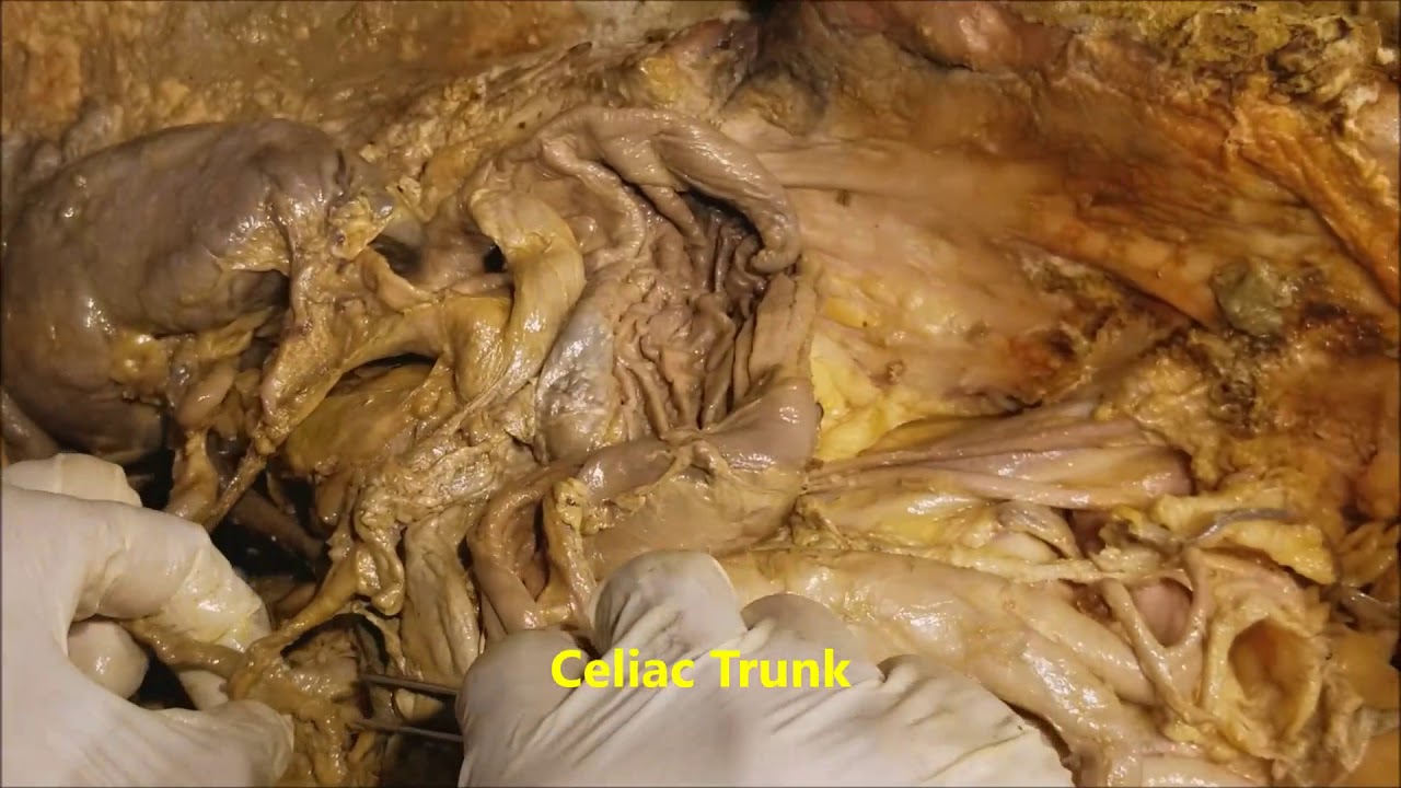 Portal Triad-Porta Hepatis Detailed Dissection - Some Variations - Sanjoy Sanyal