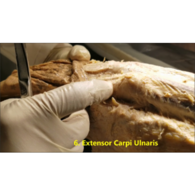 Extensor Wrist Tendons And Snuffbox Dissection-Sanjoy Sanyal icon