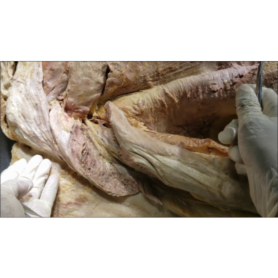 Demonstration of Triceps-Ulnar Nerve-Cubital Tunnel-Radial Nerve-Spiral Groove - Sanjoy Sanyal icon