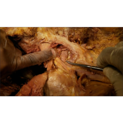 Deep Glute Muscles Dissection-Piriformis Syndrome-Sciatica-Sanjoy Sanyal icon