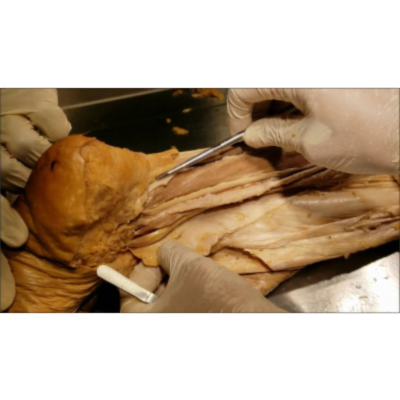 Deep Posterior Leg Muscles-Calf Pump-Peripheral Heart-DVT-Tarsal Tunnel Syndrome - Sanjoy Sanyal icon