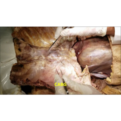 Thoracic Wall Vascular Dissection Part 2-Thoracentesis-Thoracotomy Demonstration - Sanjoy Sanyal icon