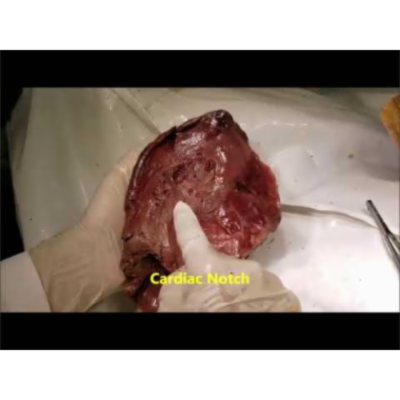 Topography and Clinical Aspects of Eviscerated Left Lung - Sanjoy Sanyal icon