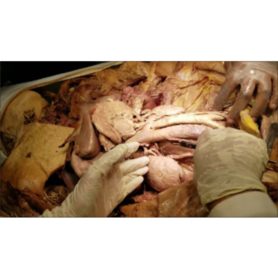 Pelvi-Calyceal-Ureteric Meticulous Dissection - Clinico-Surgical Aspects Narration – Sanjoy Sanyal icon