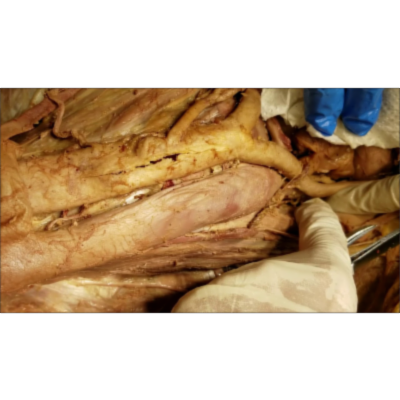 Posterior Abdominal Wall Dissection – Muscles Nerves Clinical Narration – Sanjoy Sanyal icon