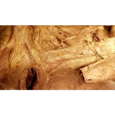 Aorta - Vena Cava - Azygos Vein - Cisterna Chyli Dissection and Clinical Narration – Sanjoy Sanyal icon