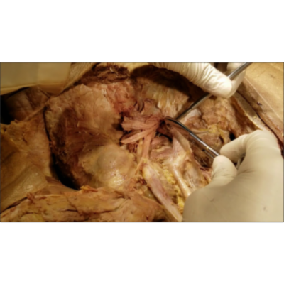 Ischioanal Fossa–Alcocks Canal–Sciatic Foramen–Pudendal Dissection-Clinical Narration–Sanjoy Sanyal