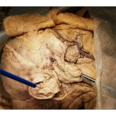Parotid Gland and Stensen Duct Dissection – Exhaustive ClinicoAnatomical Review – Sanjoy Sanyal icon