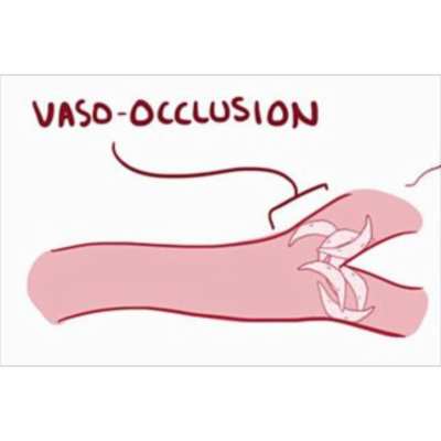 Sickle Cell Disease icon