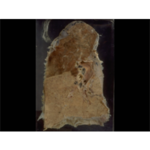 Lobar Pneumonia icon