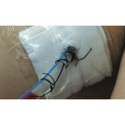 Evidence-based update on chest tube management - American Nurse Today icon