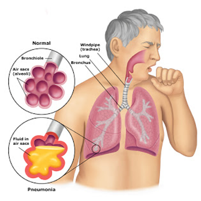 Pneumonia | National Heart, Lung, and Blood Institute (NHLBI) icon