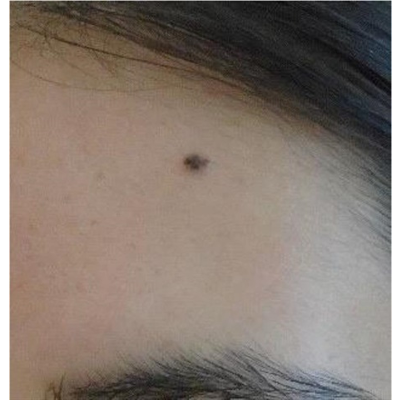 Skin Cancer: Back to Basics: Basal Cell Carcinoma : Journal of the Dermatology Nurses' Association icon