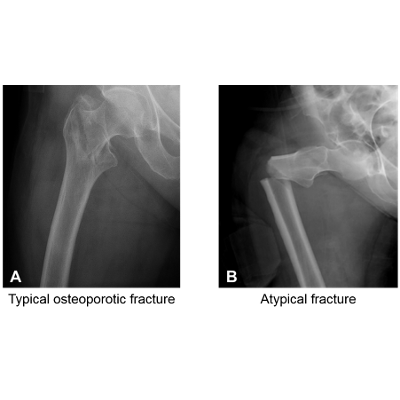 Learning exercises for the composite behavior of bone and fracture behavior of bone icon