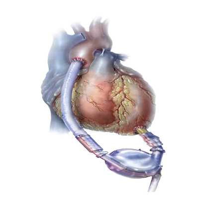 Caring for the patient with a left ventricular assist device : Nursing2020 Critical Care icon