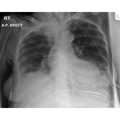 Nasogastric tubes 1: insertion technique and confirming position | Nursing Times icon