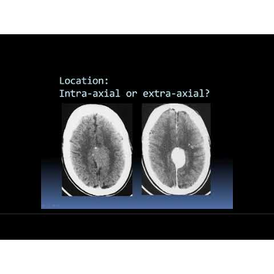 Intro to Head CT Part III: Tumor and Infection icon