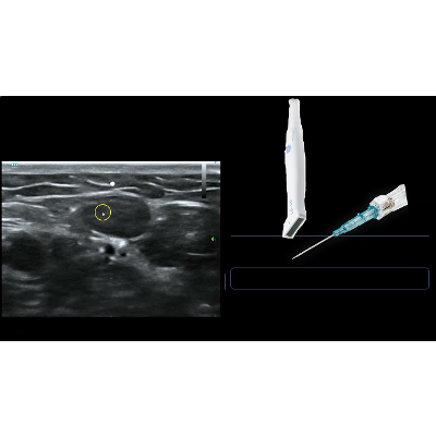 Ultrasound Guided IV Access