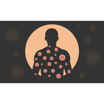 Monkeypox by the Numbers: August 22, 2022 icon