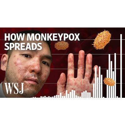 Why Monkeypox Is a Global Health Threat | WSJ