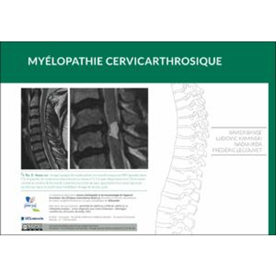 Myélopathie cervicarthrosique icon