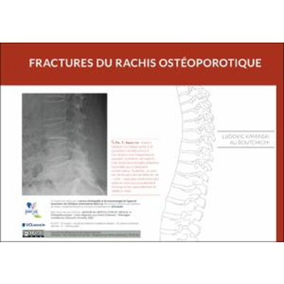 Les fractures du rachis ostéoporotique icon