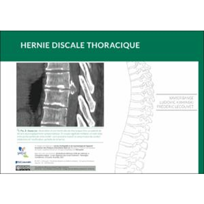 Hernie discale thoracique icon