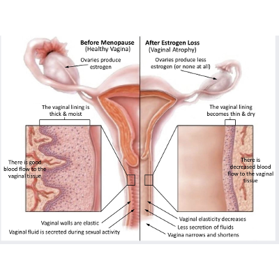 Comparing Labiaplasty vs. Vaginoplasty (Vaginal Tightening) icon
