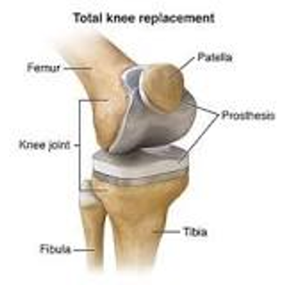Total Knee Replacement: Summary icon