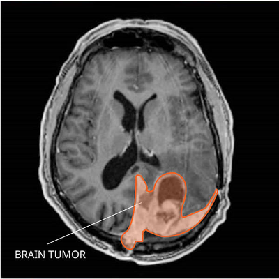 Advances in Brain and Spinal Cord Tumor Research icon