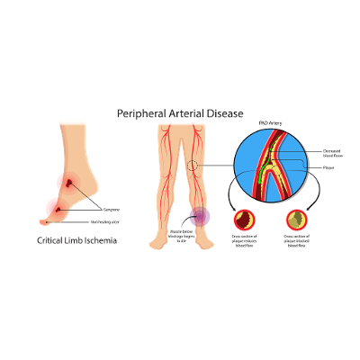 Peripheral Arterial Disease