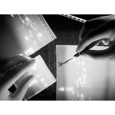 Researchers identify new genes linked to breast cancer icon